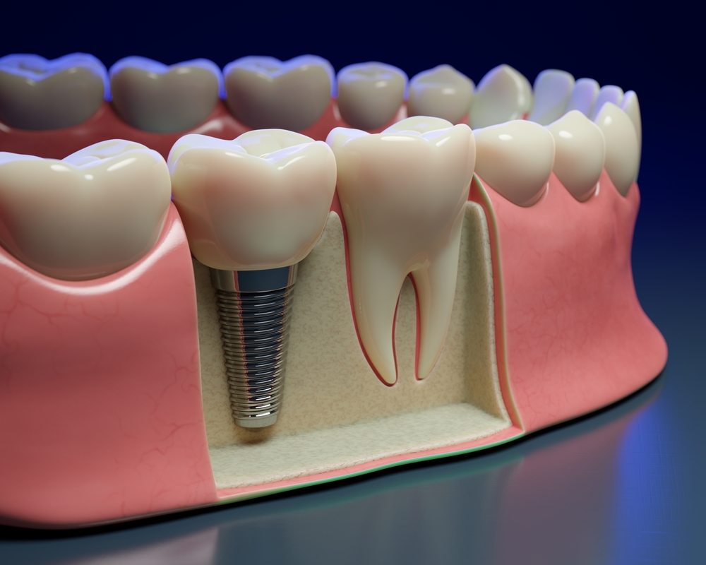 Bone Level Tapered Implant